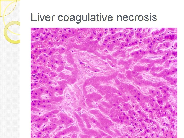 Liver coagulative necrosis 