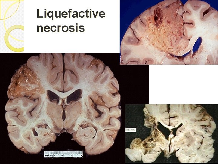 Liquefactive necrosis 