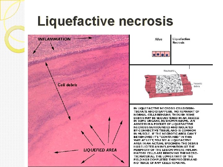 Liquefactive necrosis 
