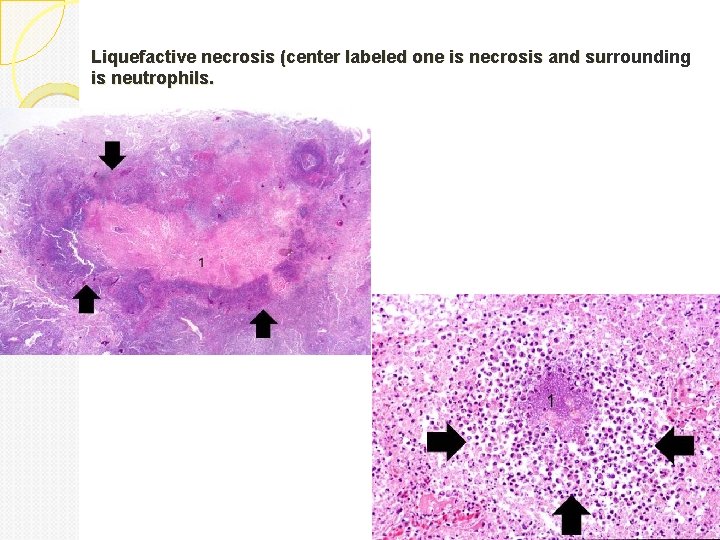 Liquefactive necrosis (center labeled one is necrosis and surrounding is neutrophils. 