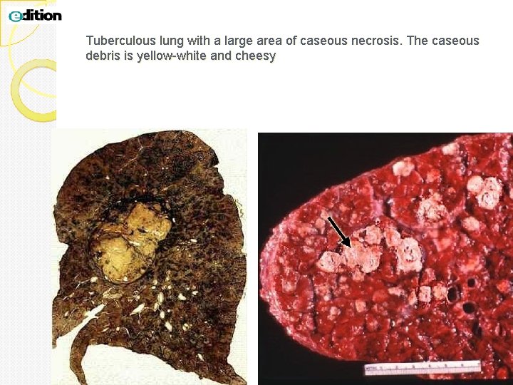 Tuberculous lung with a large area of caseous necrosis. The caseous debris is yellow-white