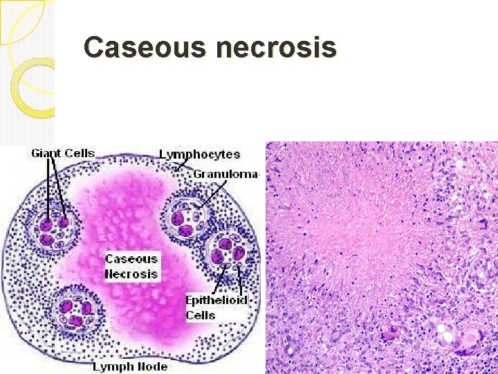 Caseous necrosis 