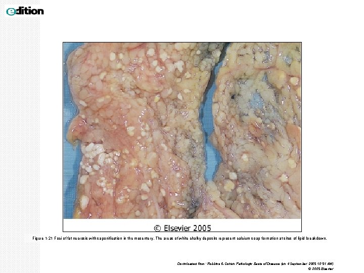 Figure 1 -21 Foci of fat necrosis with saponification in the mesentery. The areas