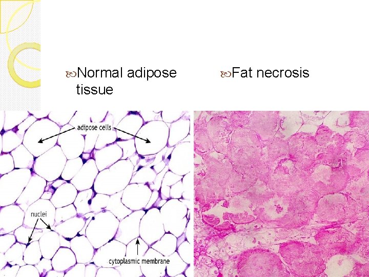  Normal adipose tissue Fat necrosis 
