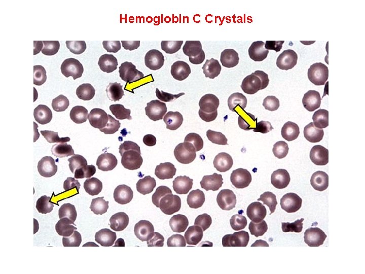 Hemoglobin C Crystals 