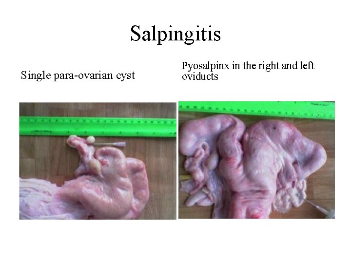 Salpingitis Single para-ovarian cyst Pyosalpinx in the right and left oviducts 