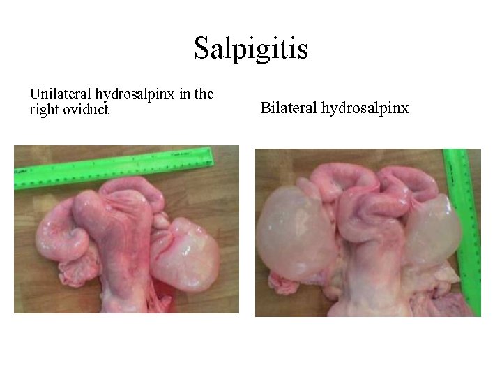 Salpigitis Unilateral hydrosalpinx in the right oviduct Bilateral hydrosalpinx 