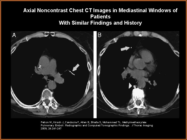 Axial Noncontrast Chest CT Images in Mediastinal Windows of Patients With Similar Findings and