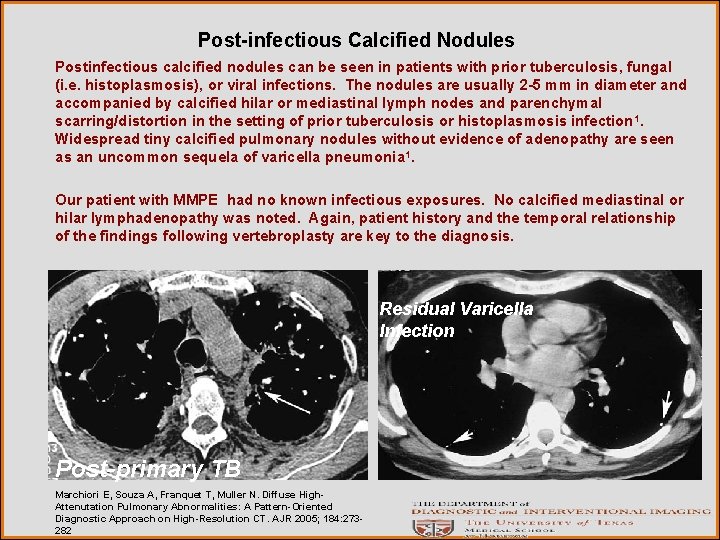 Post-infectious Calcified Nodules Postinfectious calcified nodules can be seen in patients with prior tuberculosis,