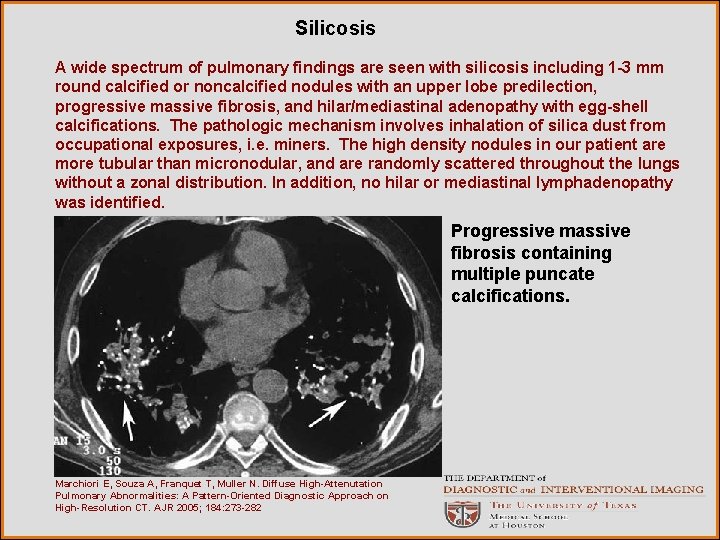 Silicosis A wide spectrum of pulmonary findings are seen with silicosis including 1 -3