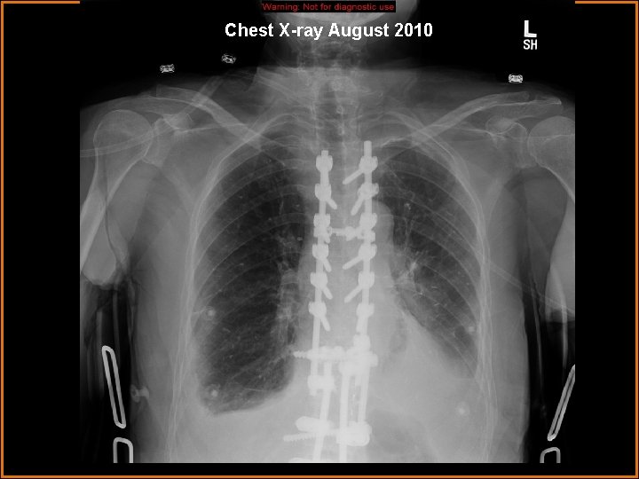 Chest X-ray August 2010 