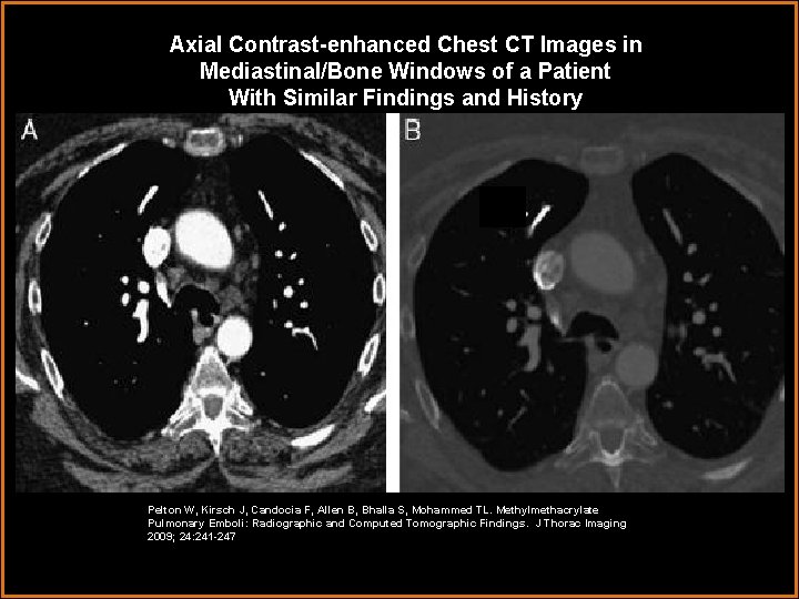 Axial Contrast-enhanced Chest CT Images in Mediastinal/Bone Windows of a Patient With Similar Findings