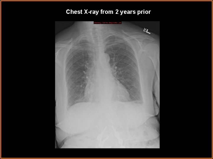 Chest X-ray from 2 years prior 