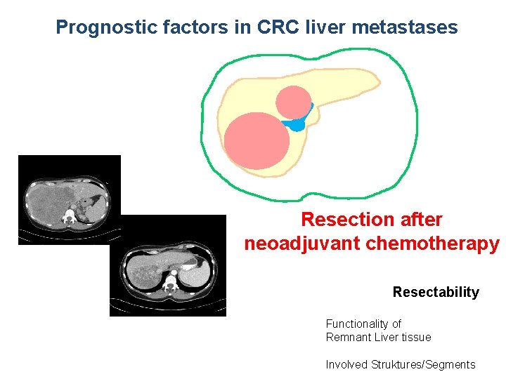 Prognostic factors in CRC liver metastases Resection after neoadjuvant chemotherapy Technical Resectability Functionality of