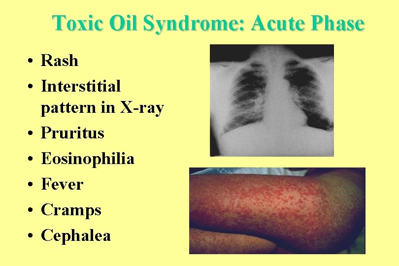 Toxic Oil Syndrome: Acute Phase • Rash • Interstitial pattern in X-ray • Pruritus