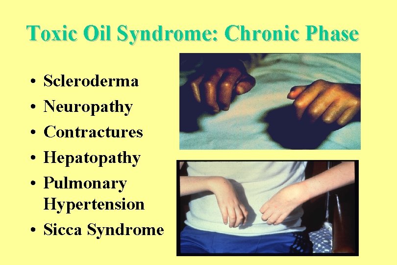 Toxic Oil Syndrome: Chronic Phase • • • Scleroderma Neuropathy Contractures Hepatopathy Pulmonary Hypertension