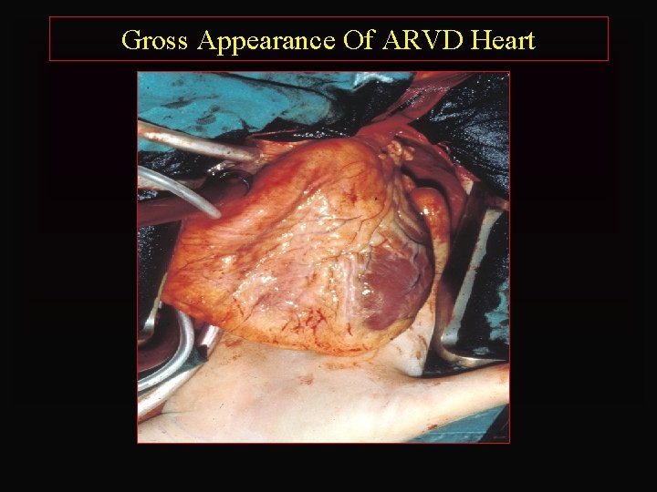 Gross Appearance Of ARVD Heart 
