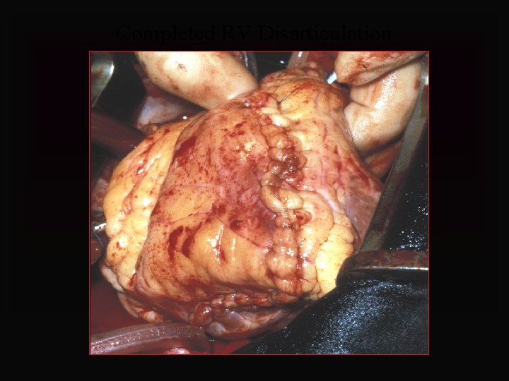 Completed RV Disarticulation 