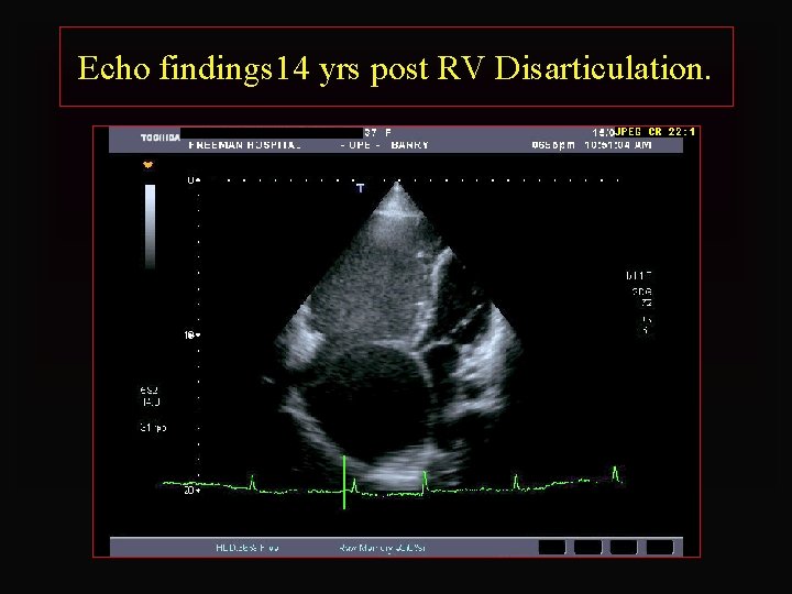 Echo findings 14 yrs post RV Disarticulation. 