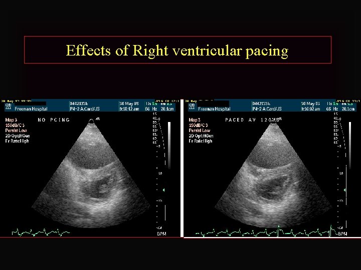 Effects of Right ventricular pacing 