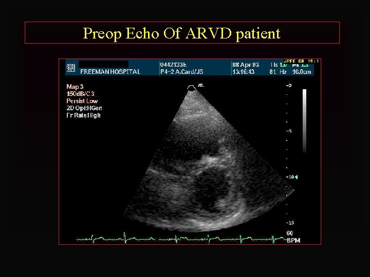 Preop Echo Of ARVD patient 