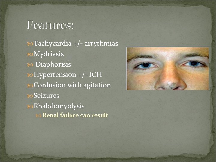 Features: Tachycardia +/- arrythmias Mydriasis Diaphorisis Hypertension +/- ICH Confusion with agitation Seizures Rhabdomyolysis