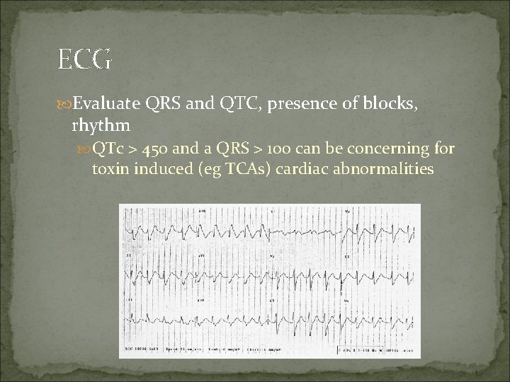 ECG Evaluate QRS and QTC, presence of blocks, rhythm QTc > 450 and a