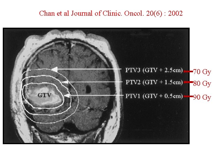 Chan et al Journal of Clinic. Oncol. 20(6) : 2002 70 Gy 80 Gy
