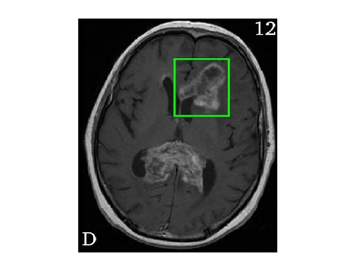 Diffusion Tensor Imaging 