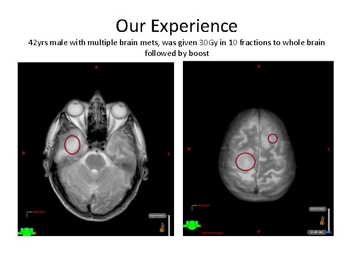Our Experience 42 yrs male with multiple brain mets, was given 30 Gy in