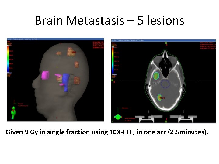 Brain Metastasis – 5 lesions Given 9 Gy in single fraction using 10 X-FFF,