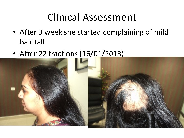 Clinical Assessment • After 3 week she started complaining of mild hair fall •