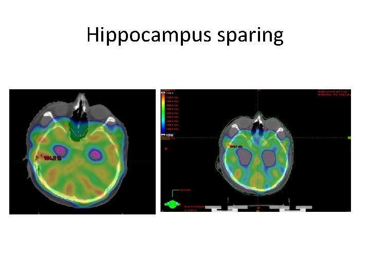 Hippocampus sparing 