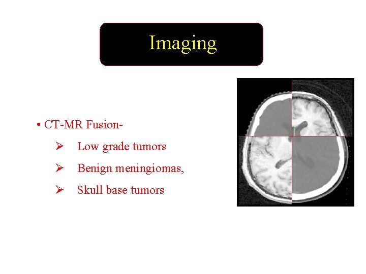 Imaging • CT-MR FusionØ Low grade tumors Ø Benign meningiomas, Ø Skull base tumors