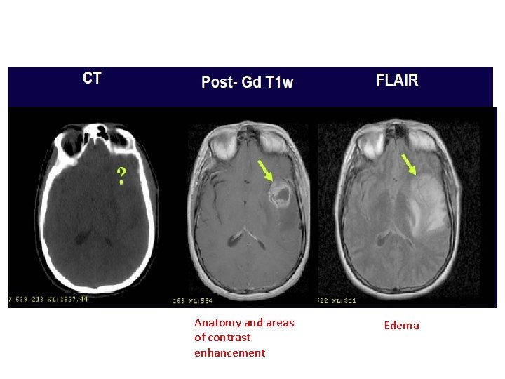 Anatomy and areas of contrast enhancement Edema 