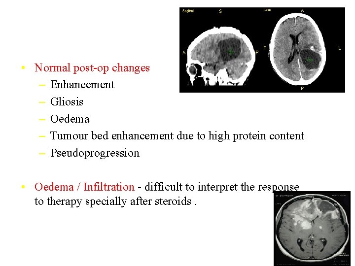  • Normal post-op changes – Enhancement – Gliosis – Oedema – Tumour bed