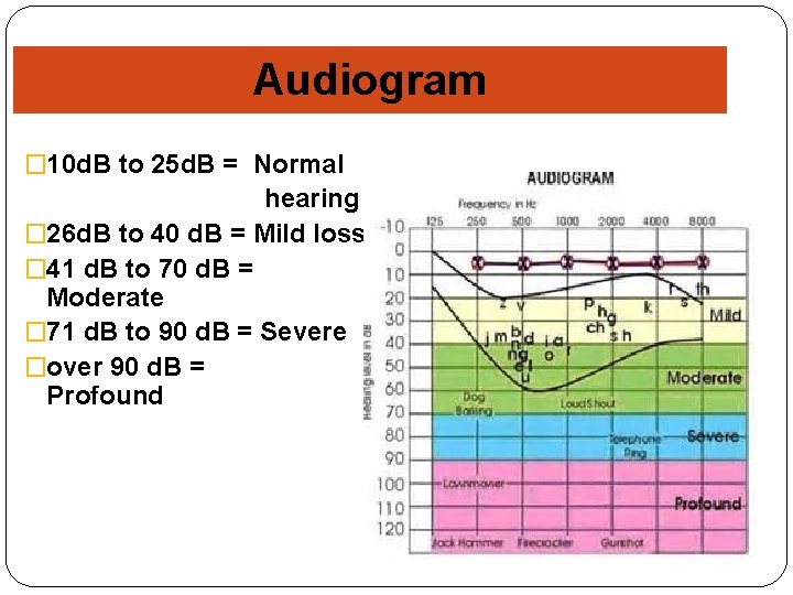Audiogram � 10 d. B to 25 d. B = Normal hearing � 26