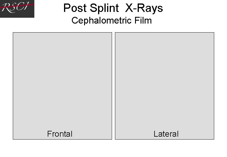 Post Splint X-Rays Cephalometric Film Frontal Lateral Post Splint X-Rays Cephalometric Film Frontal Lateral