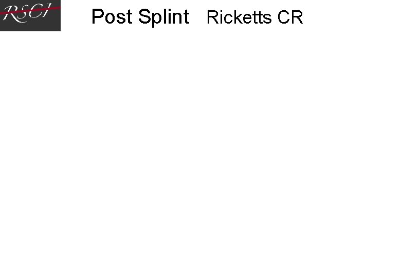 Post Splint Ricketts CR Post Splint Ricketts CR