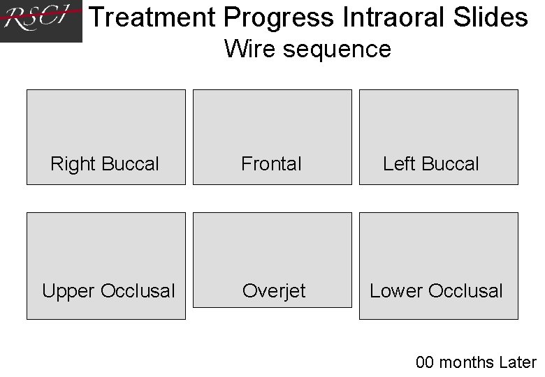 Treatment Progress Intraoral Slides Wire sequence Right Buccal Upper Occlusal Frontal Overjet Left Treatment Progress Intraoral Slides Wire sequence Right Buccal Upper Occlusal Frontal Overjet Left