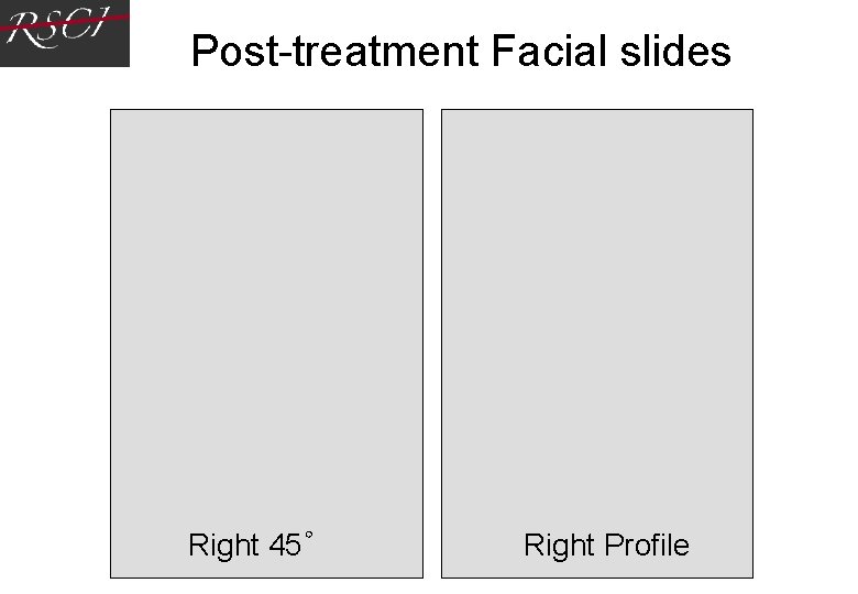 Post-treatment Facial slides Right 45゜ Right Profile Post-treatment Facial slides Right 45゜ Right Profile