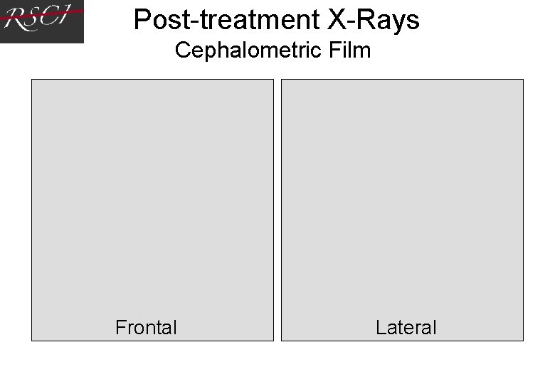 Post-treatment X-Rays Cephalometric Film Frontal Lateral Post-treatment X-Rays Cephalometric Film Frontal Lateral