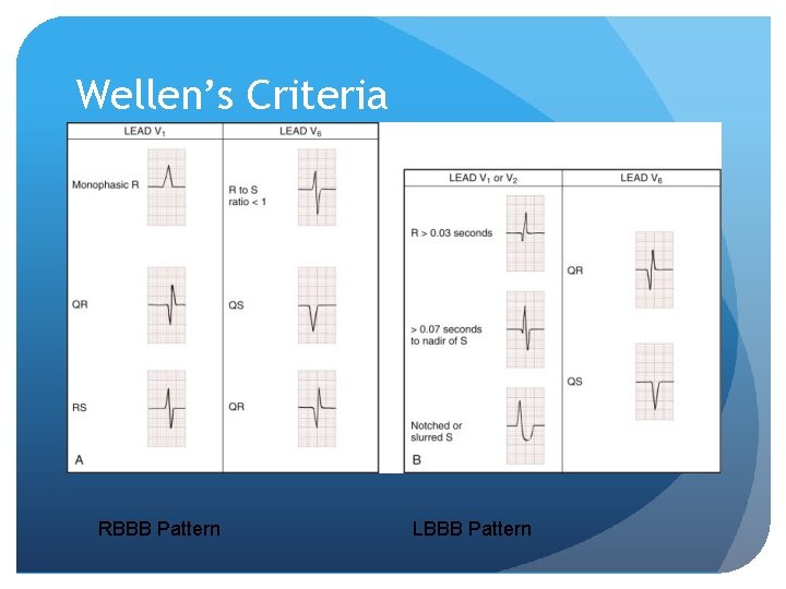 Wellen’s Criteria RBBB Pattern LBBB Pattern 