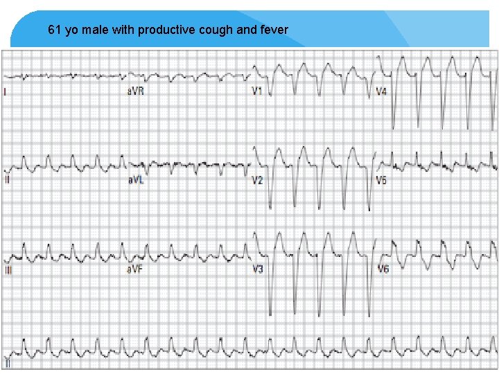 61 yo male with productive cough and fever 