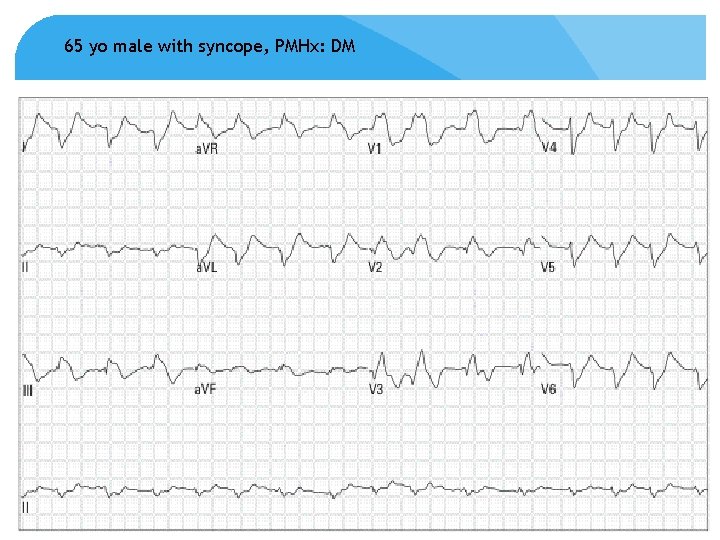 65 yo male with syncope, PMHx: DM 