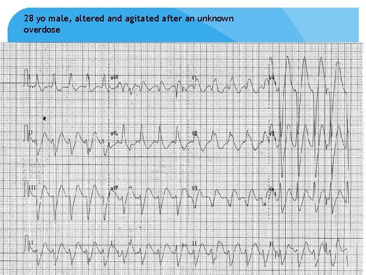 28 yo male, altered and agitated after an unknown overdose 