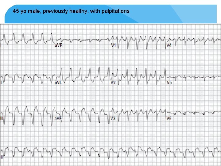 45 yo male, previously healthy, with palpitations 