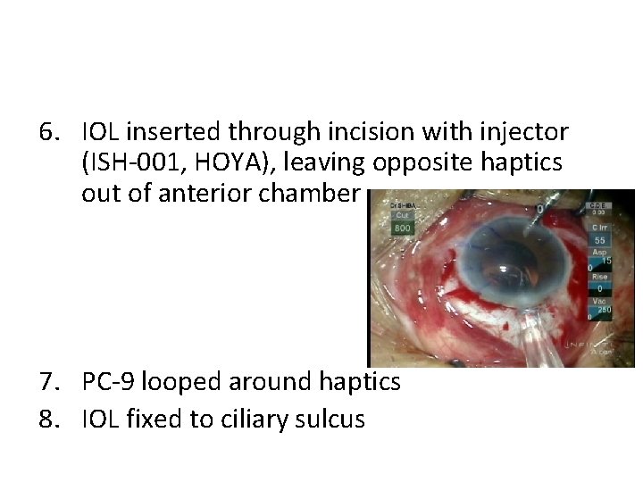 6. IOL inserted through incision with injector (ISH-001, HOYA), leaving opposite haptics out of