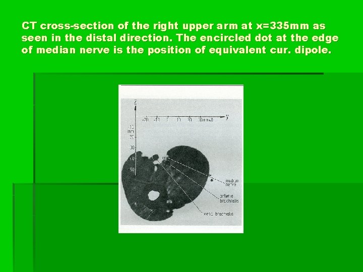 CT cross-section of the right upper arm at x=335 mm as seen in the