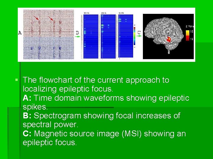 § The flowchart of the current approach to localizing epileptic focus. A: Time domain